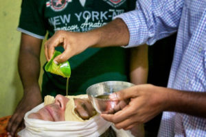 Dr. Arun demonstrating Netratarpanam नेत्रतर्पणं (eye rejuvenation treatment)